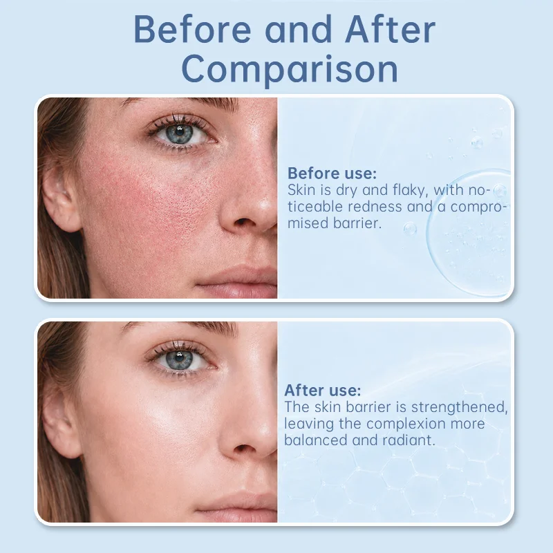 Side-by-side close-up images of a woman's face before and after skincare treatment, showing reduced redness and improved complexion.